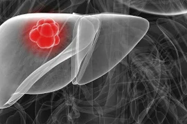 Người Việt bị ung thư gan nhiều nhất thế giới