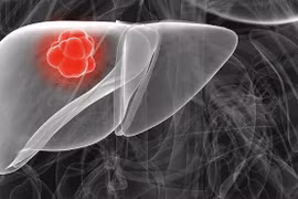 Người Việt bị ung thư gan nhiều nhất thế giới