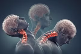 1 số dấu hiệu chỉ điểm bạn đã thoát vị đĩa đệm, thoái hóa cột sống cổ