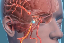 Chụp cộng hưởng từ mới phát hiện phình mạch não 