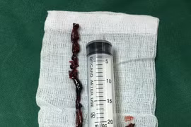 Lấy đoạn huyết khối dài hơn 40cm tránh cắt cụt chi