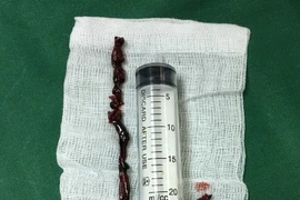 Lấy đoạn huyết khối dài hơn 40cm tránh cắt cụt chi