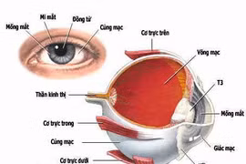 Viêm dây thần kinh thị giác do bệnh toàn thân