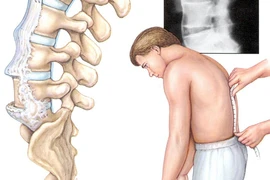 Đau thắt lưng và biểu hiện của cột sống dính khớp