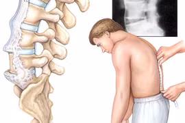 Đau thắt lưng và biểu hiện của cột sống dính khớp
