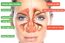 Cách nhận biết viêm xoang mặt