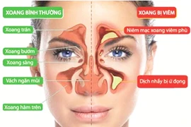 Cách nhận biết viêm xoang mặt