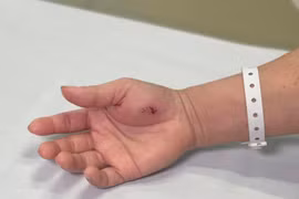 Hy hữu: Ngộ độc vì bị Cu li cắn