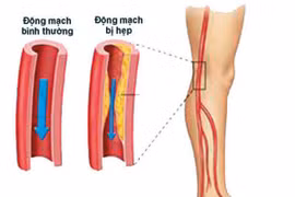 Cách phòng ngừa bệnh động mạch chi dưới tránh hoại tử