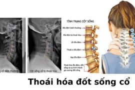 Thoái hóa cổ do nằm sofa xem tivi