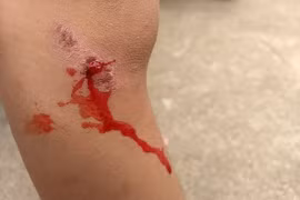 Mất cảm giác đau - một căn bệnh nguy hiểm 