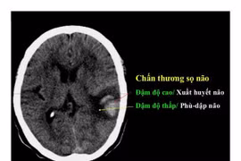 Điều trị chấn thương sọ não nặng nhờ đặt máy đo áp lực nội sọ