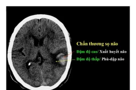 Điều trị chấn thương sọ não nặng nhờ đặt máy đo áp lực nội sọ