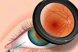 Tránh bị đục thủy tinh thể