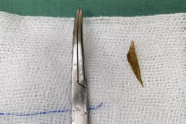 Chiếc xương cá đâm ra ngoài ruột non