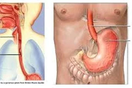 Giãn tĩnh mạch thực quản độ mấy phải thắt?