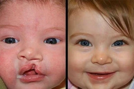 Thời điểm tốt nhất để phẫu thuật hở môi 