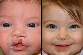 Thời điểm tốt nhất để phẫu thuật hở môi 