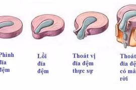 Nội soi “giải liệt” cho thoát vị đĩa đệm chèn ép ống sống