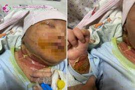 Ngại dịch COVID-19 không đến khám, bé 21 ngày tuổi viêm da mủ nặng