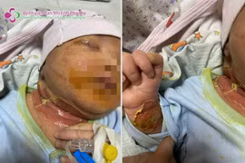 Ngại dịch COVID-19 không đến khám, bé 21 ngày tuổi viêm da mủ nặng
