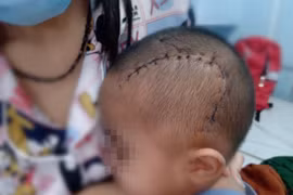 Nếu bệnh nhi được điều trị đúng ngay từ đầu, diễn tiến có thể đáp ứng thuốc mà không cần phẫu thuật vì áp xe não.