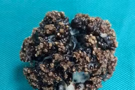 Khối u xơ tuyến tiền liệt to như quả cam