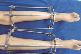 Kéo dài chân: Không chỉ giấc mơ chân dài