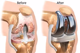 Những lưu ý khi thay khớp gối nhân tạo 