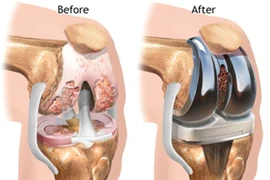 Những lưu ý khi thay khớp gối nhân tạo 