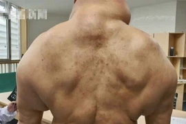 Biến thành dị dạng như “quái vật” vì uống 1 lít rượu/ngày