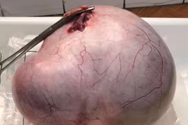 Cụ bà 67 tuổi mang u buồng trứng 3,7kg