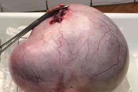 Cụ bà 67 tuổi mang u buồng trứng 3,7kg