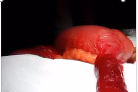 Xoắn túi thừa Meckel -dễ nhầm với viêm ruột thừa