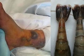Nguy cơ tử vong cao do ăn hải sản nhiễm vi khuẩn Vibrio vulnificus