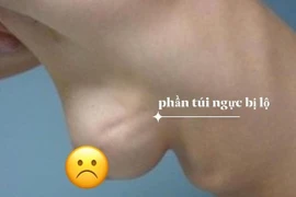 Nâng ngực bị lộ túi