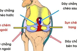 Tổn thương dây chằng khớp sau mổ hay điều trị?