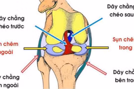 Tổn thương dây chằng khớp sau mổ hay điều trị?