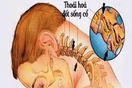 Hội chứng bệnh lý gây thoái hóa cột sống cổ