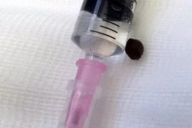 Hạt tiêu được lấy ra khỏi phổi bệnh nhân