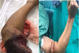 Bảo quản chi thể đứt rời đúng cách 