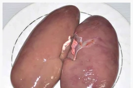 Bầu dục hầm thuốc trị hoa mắt, ù tai do huyết áp thấp