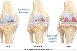 4 giai đoạn của thoái hóa khớp gối