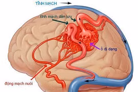 Mất mạng vì chủ quan với đau đầu