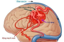 Mất mạng vì chủ quan với đau đầu