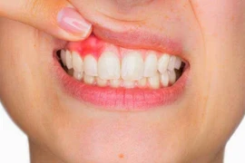 Những nguyên nhân cần lưu ý khi xuất hiện tình trạng chảy máu nướu khi đánh răng