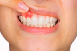 Những nguyên nhân cần lưu ý khi xuất hiện tình trạng chảy máu nướu khi đánh răng