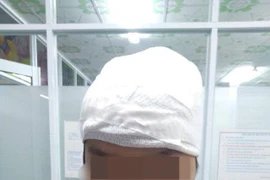 Vi phẫu tạo hình cho bé gái bị mất nửa phần da đầu 