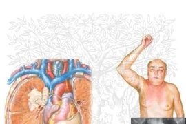 Phù tay do u ác tính cẩn thận mất mạng