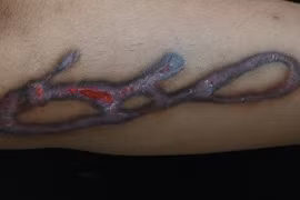 Sẹo phì đại sau xóa xăm